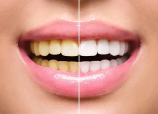 Professional-Teeth-Whitening