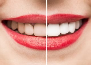 teeth-whitening-before-after-1